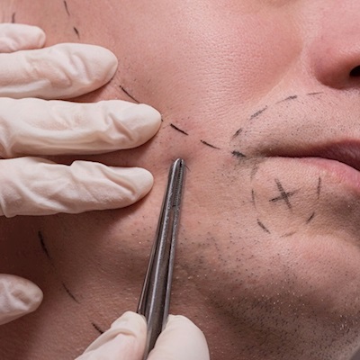 Beard and Moustache Transplantation