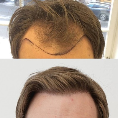 Do Hair Transplant Results Look Natural?